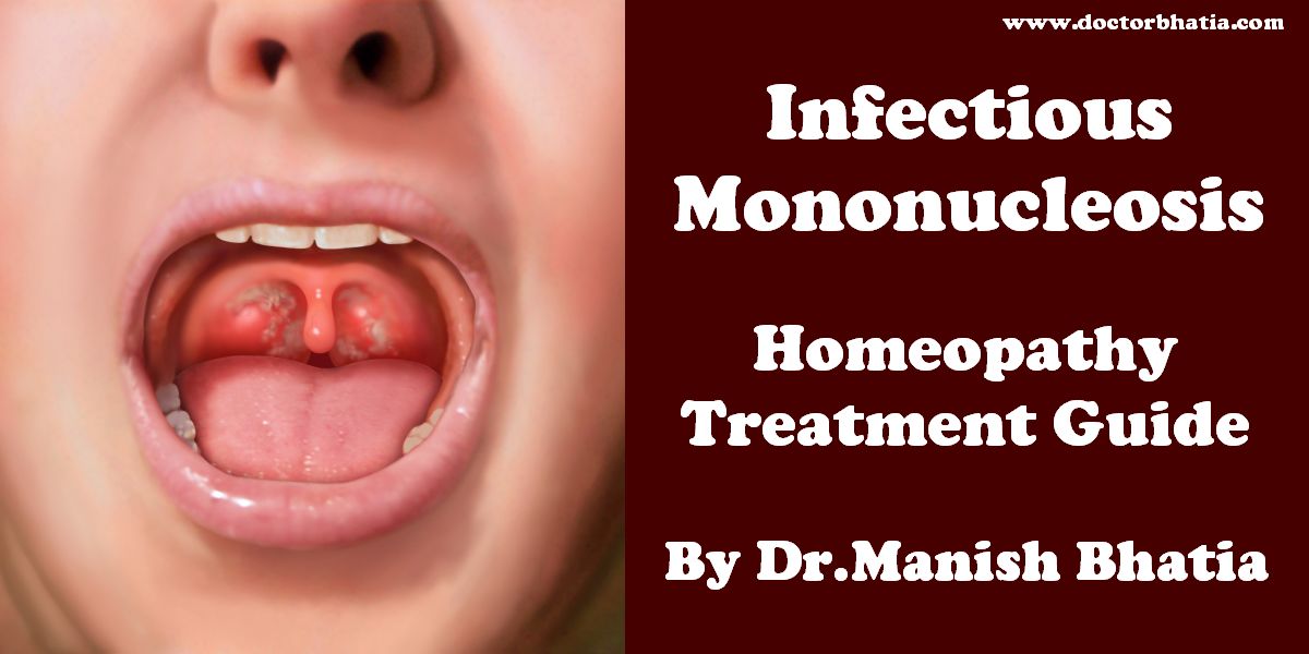 Infectious mononucleosis - Homeopathy Treatment and Homeopathic Remedies -  Doctor Bhatia